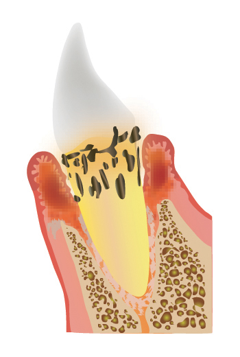 高度の歯周病